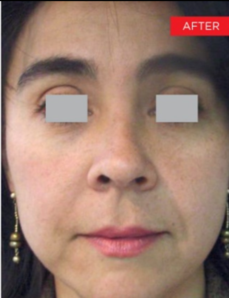 Fotona 4D NonSurgical Face Lift in Ottawa alchemistlaser