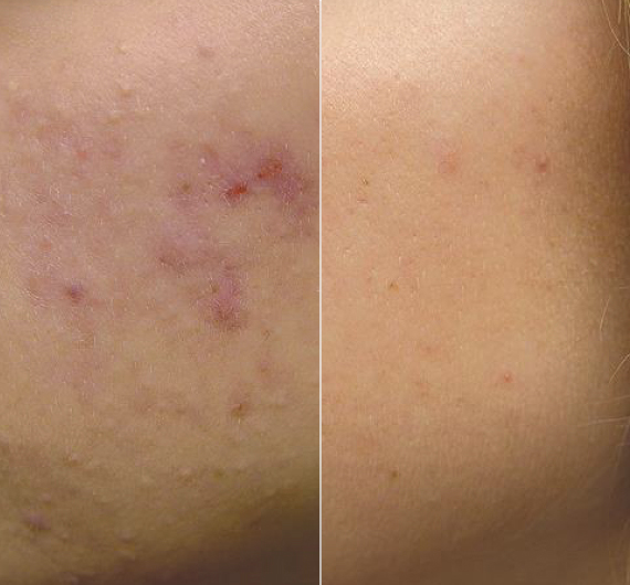 Fotona Laser Treatment Premier Skin Rejuvenation Skin Clinic Ottawa