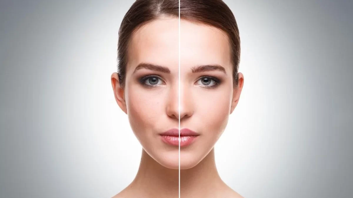 Micro Laser Peels with Fotona SP Dynamis: A Powerful Solution for Skin Rejuvenation and Hyperpigmentation
