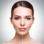 Micro Laser Peels with Fotona SP Dynamis: A Powerful Solution for Skin Rejuvenation and Hyperpigmentation