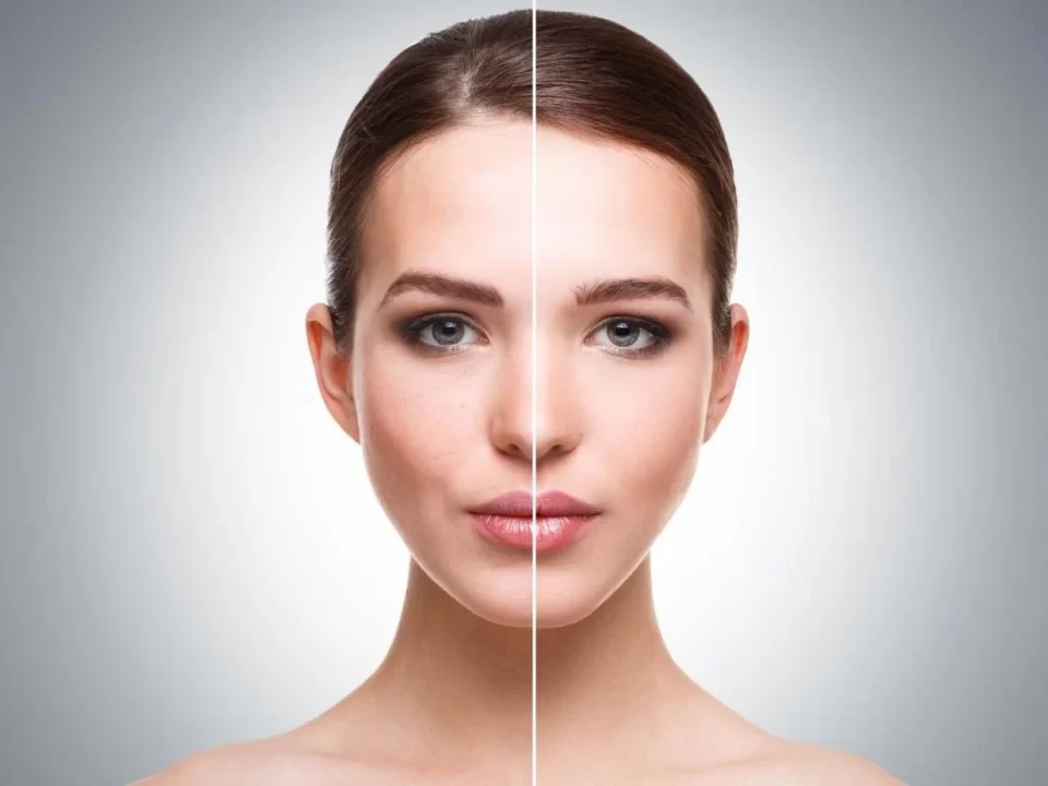 Micro Laser Peels with Fotona SP Dynamis: A Powerful Solution for Skin Rejuvenation and Hyperpigmentation