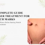 The Complete Guide to Laser Treatment for Stretch Marks: Everything to Know Before Starting Stretch Mark Laser Treatment