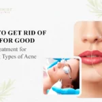 How to Get Rid of Acne for Good: Laser Treatment for Different Types of Acne